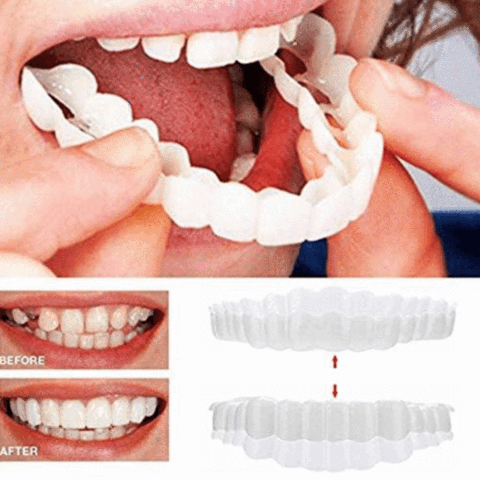 Parfait Smile Snap Sur Braces